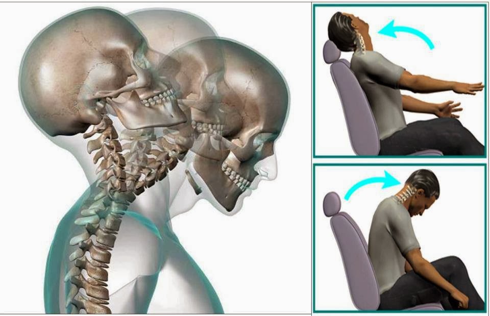 LATIGAZO CERVICAL: LAS DOS CARAS DE UNA MISMA MONEDA